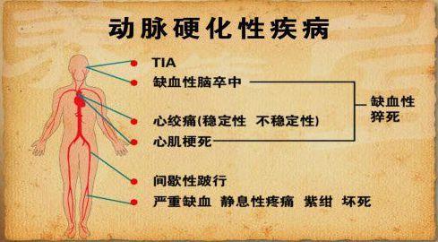 动脉硬化_动脉硬化到底是怎么回事