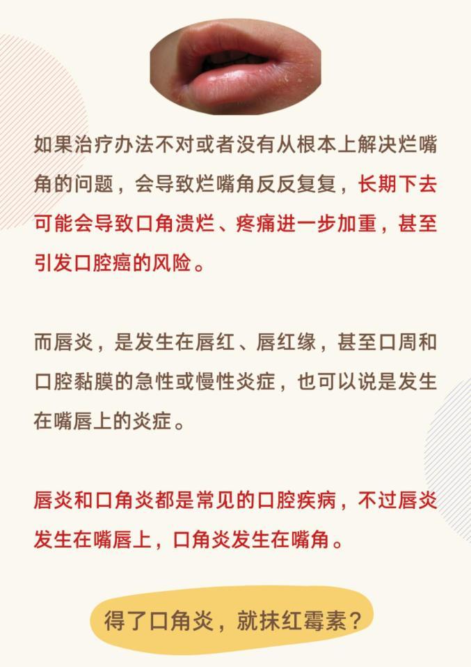 口角炎怎么办_口角炎怎么办最快最有效