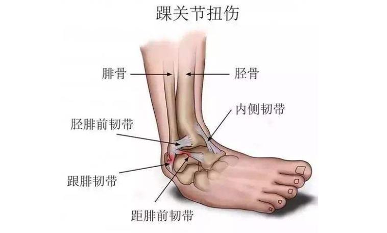 脚崴了怎么快速恢复_下楼脚崴了怎么快速恢复