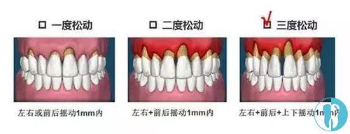 牙齿松动了能恢复吗_40岁牙齿松动了能恢复吗