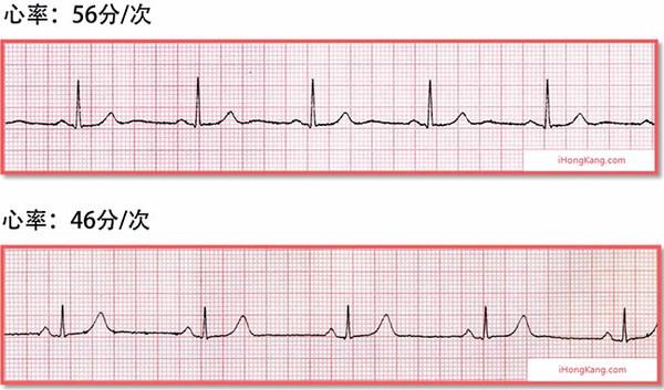 心电图窦性心动过缓_心电图窦性心动过缓是什么意思