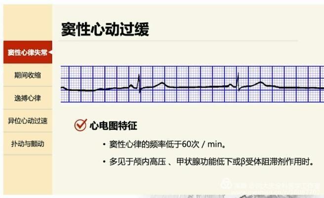 心电图窦性心动过缓_心电图窦性心动过缓是什么意思