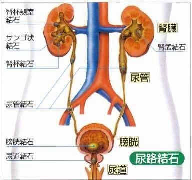 尿结石_尿结石怎样可以最快排出