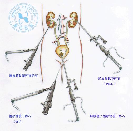 尿结石_尿结石怎样可以最快排出