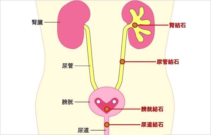 尿结石_尿结石怎样可以最快排出